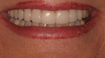 After teeth whitening procedure