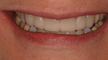 After the use of porcelain veneers