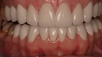 Teeth after cosmetic treatment