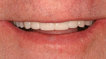 After tooth restoration