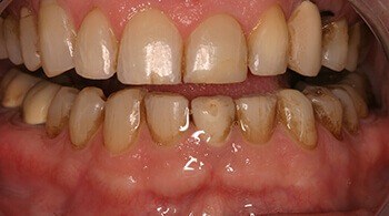 Before tooth restoration