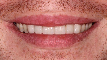 Perfect smile after Invisalign and cosmetic dentistry