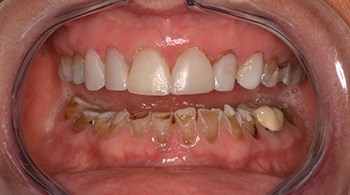 Becky's full upper and lower teeth before dental restoration