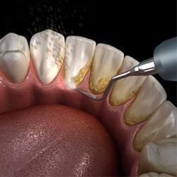 computer model of plaque being cleared from teeth