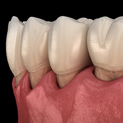 computer model of plaque being cleared from teeth revealing gum tissue recession