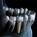 Digital illustration of dental implant bridge in Grapevine