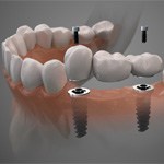 Digital illustration of dental implant bridge in Grapevine