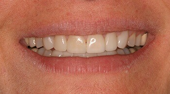 After porcelain veneers