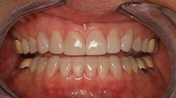 After porcelain veneers by Dr. Martin