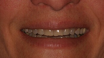 Before porcelain veneers