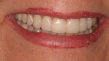 After teeth whitening