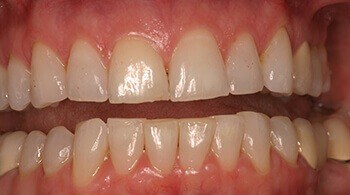 Before teeth whitening procedure