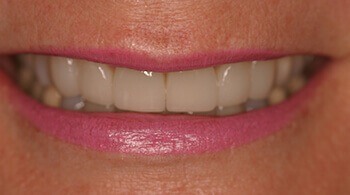 After porcelain veneers procedure