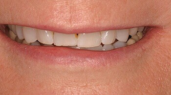 Before the use of porcelain veneers