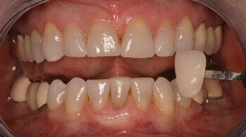 Comparing porcelain veneer next to teeth