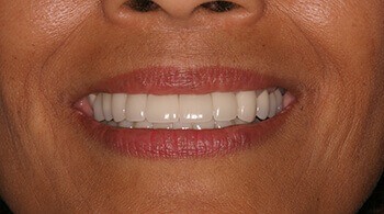 Teeth after porcelain veneers