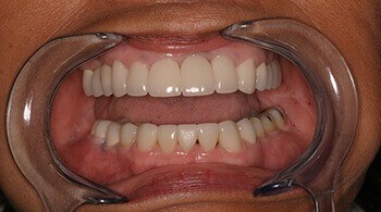 After porcelain veneers treatment