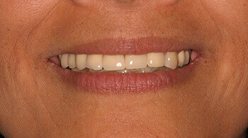 Teeth before porcelain veneers