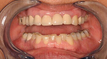 Before porcelain veneers treatment