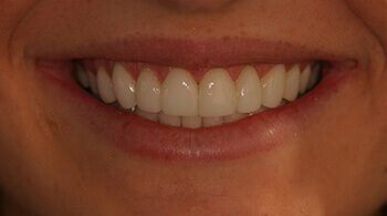 Teeth with porcelain veneers
