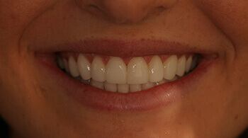 Teeth aligned with porcelain veneers