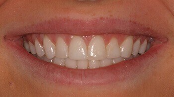 Teeth without porcelain veneers