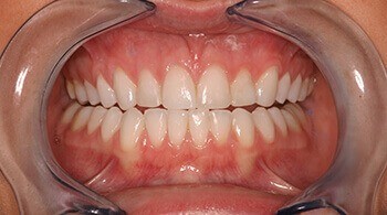 Misaligned teeth