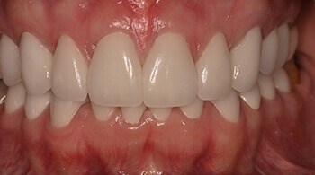 Now correctly aligned teeth