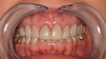 Teeth before cosmetic treatment