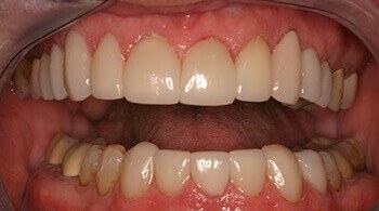 After restoration of teeth