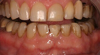 Before tooth restoration