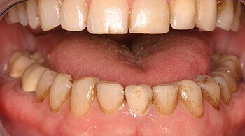 Before restoration of teeth