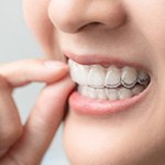 Closeup of patient putting on clear aligner
