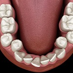 Illustration of crooked teeth