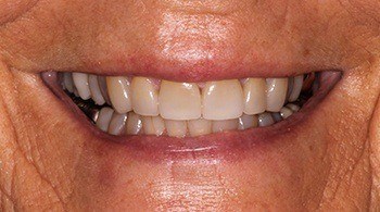 Beautiful smile after cosmetic dentistry