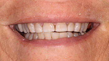 Stubby teeth before cosmetic dentistry