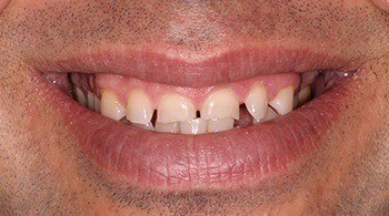 Large spaces between teeth before Invisalign