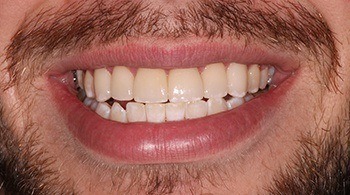 Bright white smile after cosmetic dentistry