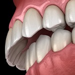 Illustration of an overbite