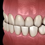Illustration of an underbite