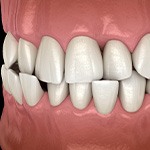 Illustration of a crossbite