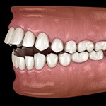 Illustration of an open bite