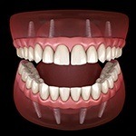 Animated All-on-4 dental implants in Grapevine