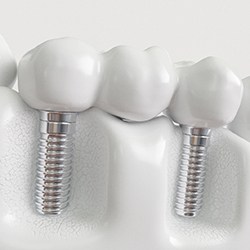 An implant bridge in Grapevine