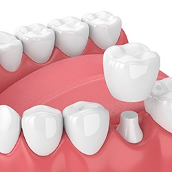 Dental crown in Grapevine