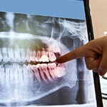 X-Ray of damaged teeth
