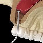 sinus lift procedure