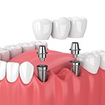dental bridge supported by two dental implant posts