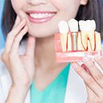 dental implant lying on top of a stack of money