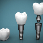 abutment and crown being placed on top of a dental implant